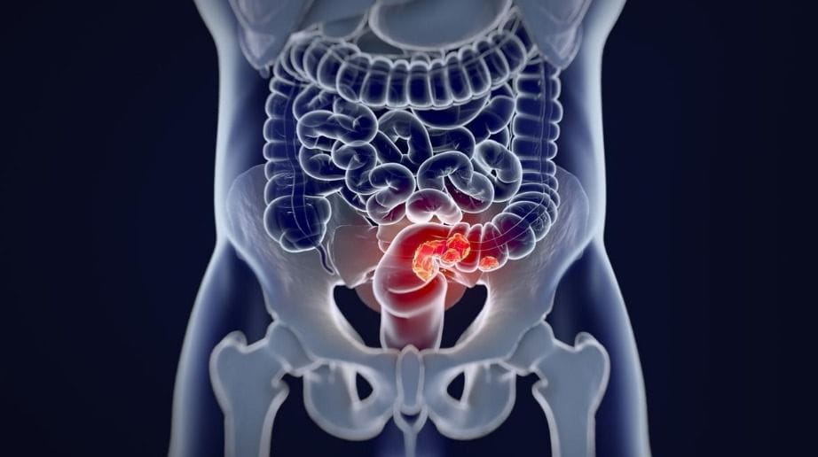 Câncer colorretal: incidência cresce entre jovens