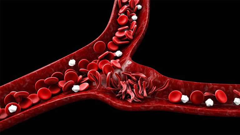 Teste genético para planejamento familiar em casos de anemia falciforme